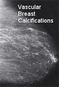 Breast Calcifications