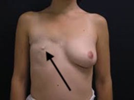 Breast Cancer Recurrence