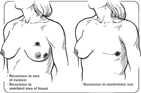 Breast Cancer Recurrence