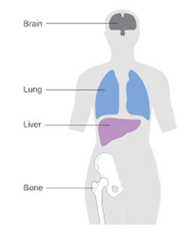 Breast Cancer Recurrence