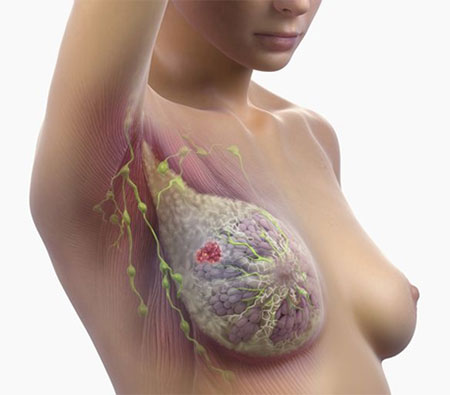 Breast Cancer Recurrence