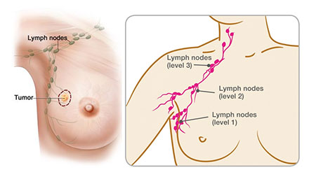 Breast Cancer Recurrence