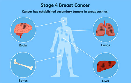 aggressive cancer recurrence)