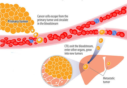 Breast Cancer Recurrence