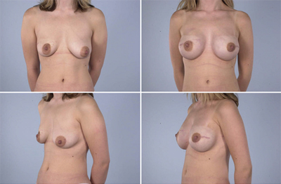 Nipple-Sparing Mastectomy (NSM)