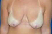 Normal Breasts