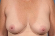 Normal Breasts
