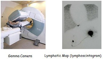 Gamma Camera, Lymphatic Map (lymphoscintogram)