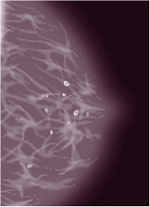 Breast Calcifications