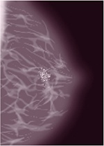 Breast Calcifications