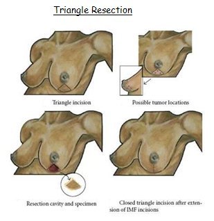 Triangle Resection