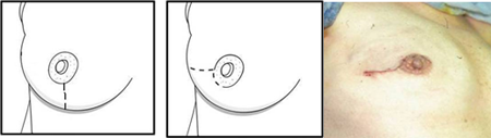 Nipple - Sparing Mastectomy (NSM) 