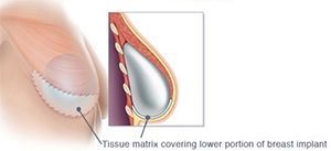 Acellular Dermal Matrices