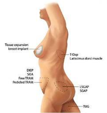 Autologous Tissue