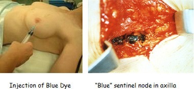 Blue Dye Injection