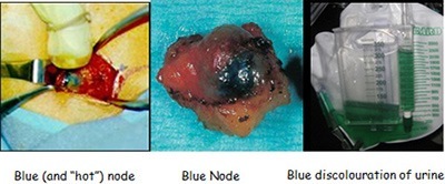 Blue (and “hot”) node, Blue discolouration of urine