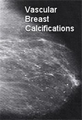 Breast Calcifications