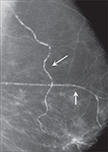 Breast Calcifications