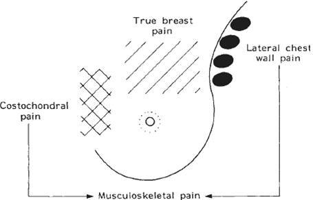 Breast Pain/Mastalgia