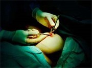 Breast Surgery