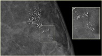 Breast Calcifications