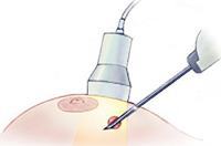 Needle Aspiration