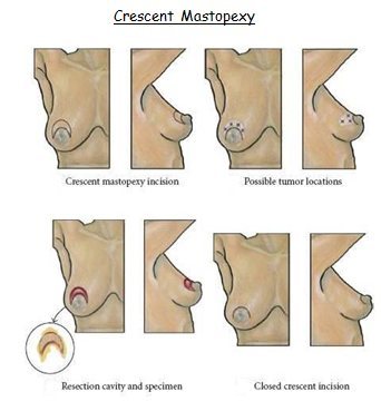 Crescent Mastopexy