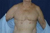 Bilateral Simple Mastectomy