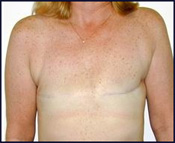 Bilateral Simple Mastectomy