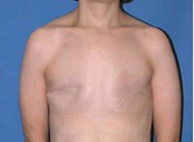 Bilateral Simple Mastectomy