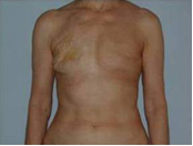 Bilateral Simple Mastectomy