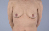 Nipple-Sparing Mastectomy (NSM)