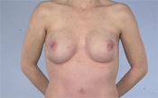 Nipple-Sparing Mastectomy (NSM)