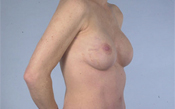 Nipple-Sparing Mastectomy (NSM)