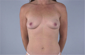 Nipple-Sparing Mastectomy (NSM)