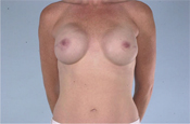 Nipple-Sparing Mastectomy (NSM)