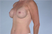 Nipple-Sparing Mastectomy (NSM)