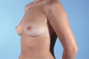 Nipple-Sparing Mastectomy (NSM)