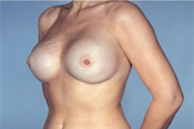 Nipple-Sparing Mastectomy (NSM)