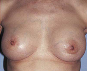 Nipple-Sparing Mastectomy (NSM)