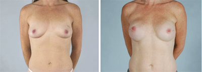 Nipple-Sparing Mastectomy (NSM)