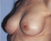 Nipple-Sparing Mastectomy (NSM)