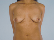 Nipple-Sparing Mastectomy (NSM)