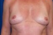 Normal Breasts