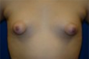 Normal Breasts