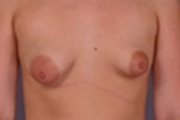 Normal Breasts