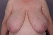 Normal Breasts