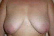 Normal Breasts