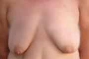 Normal Breasts