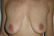 Normal Breasts